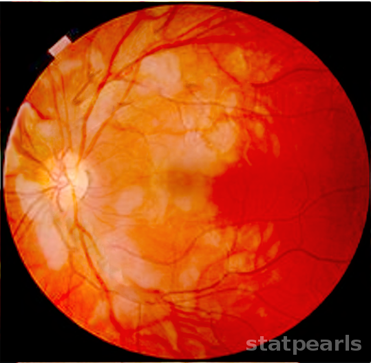 Purtscher Retinopathy