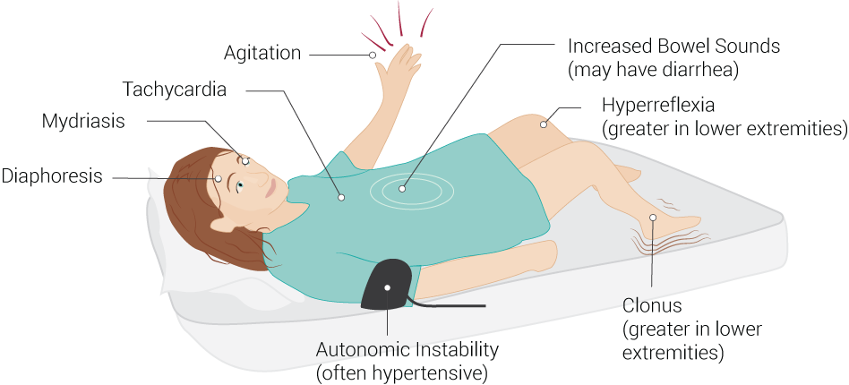 <p>Common Signs of Serotonin Syndrome