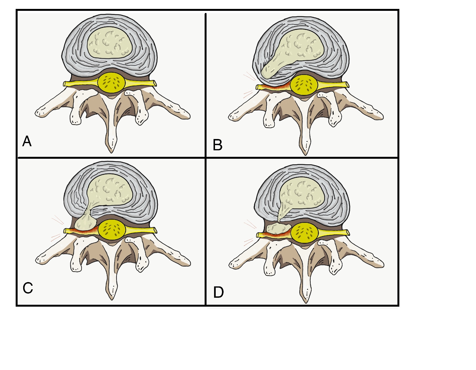 Figure 1. A) Normal disc anatomy B) Disc Protrusion C) Disc Extrusion D) Disc Sequestration