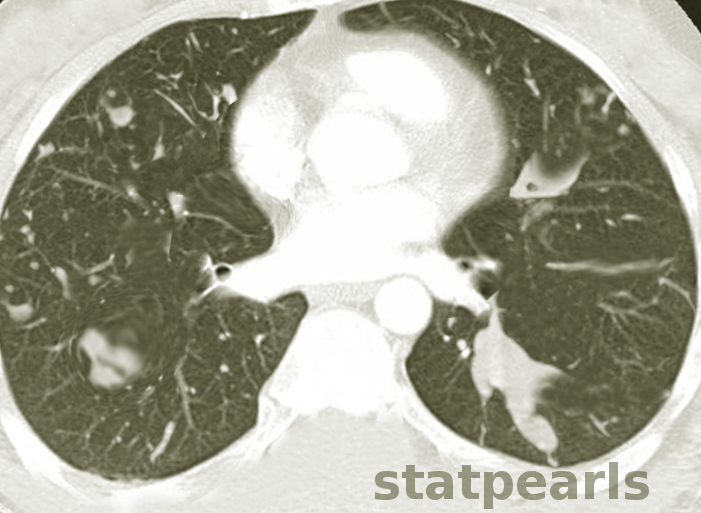 allergic bronchopulmonary aspergillosis