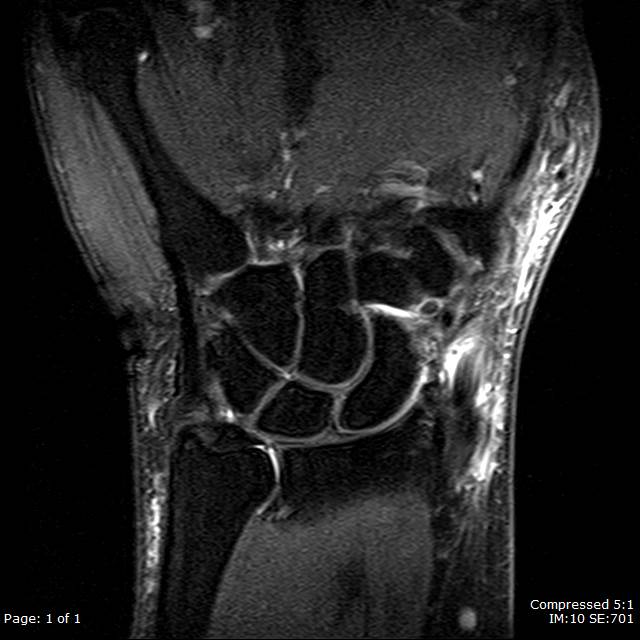 Coronal T2FS sequence of the wrist shows fluid in the first dorsal compartment tendon sheaths surrounding the abductor pollicis longus (APL) and extensor pollicis brevis (EPB) tendons with associated tendinosis and surrounding soft tissue inflammation