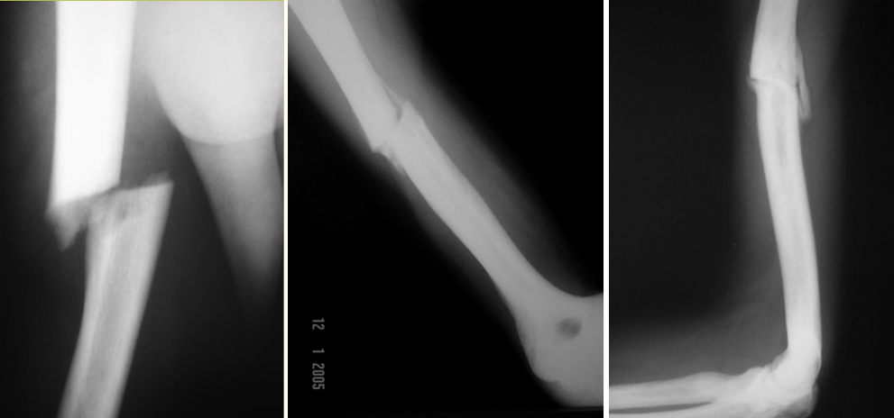 Humerus fracture and consolidation.