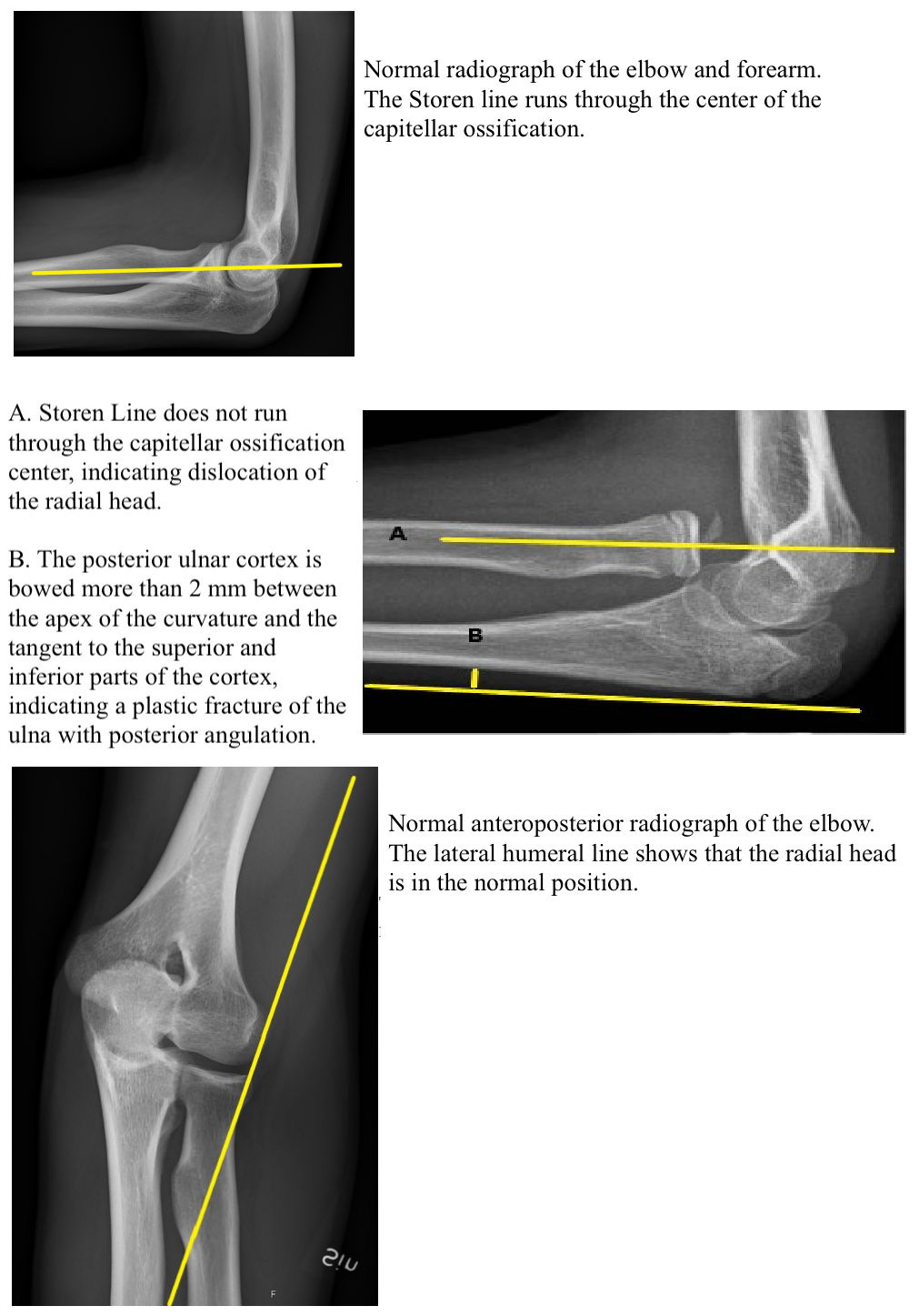 <p>Radial Head Dislocation</p>