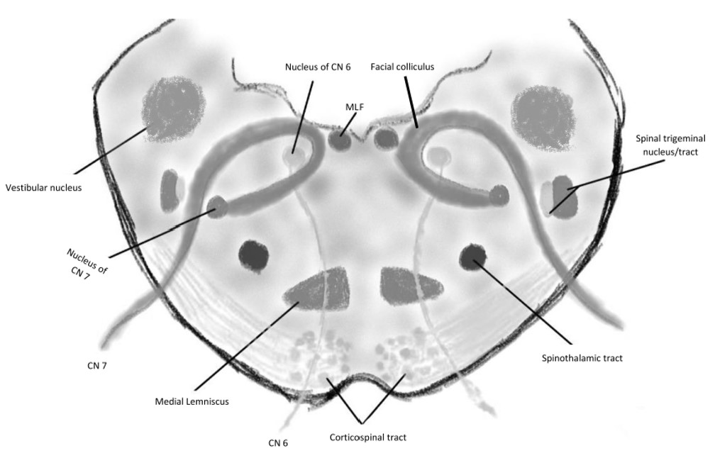 Anatomy of Foville Syndrome at the level of the inferomedial pons