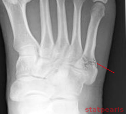 Jones fracture