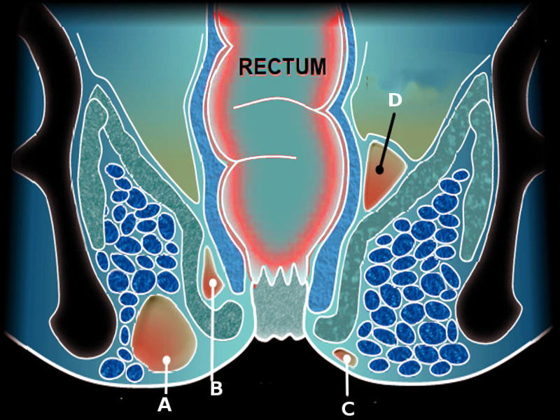 Perirectal abscess