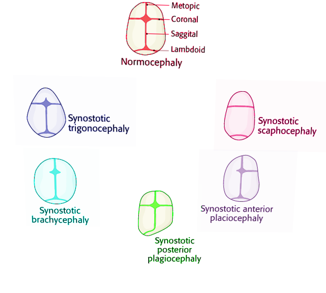 Craniosynostosis