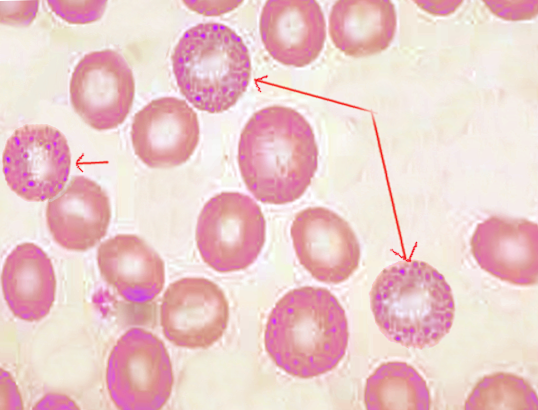 Basophilic stipling