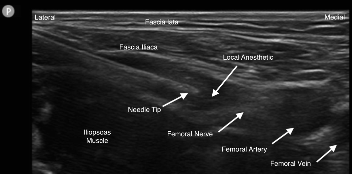 <p>Femoral Nerve Block</p>