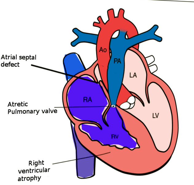 Pulmonary atresia with intact VS