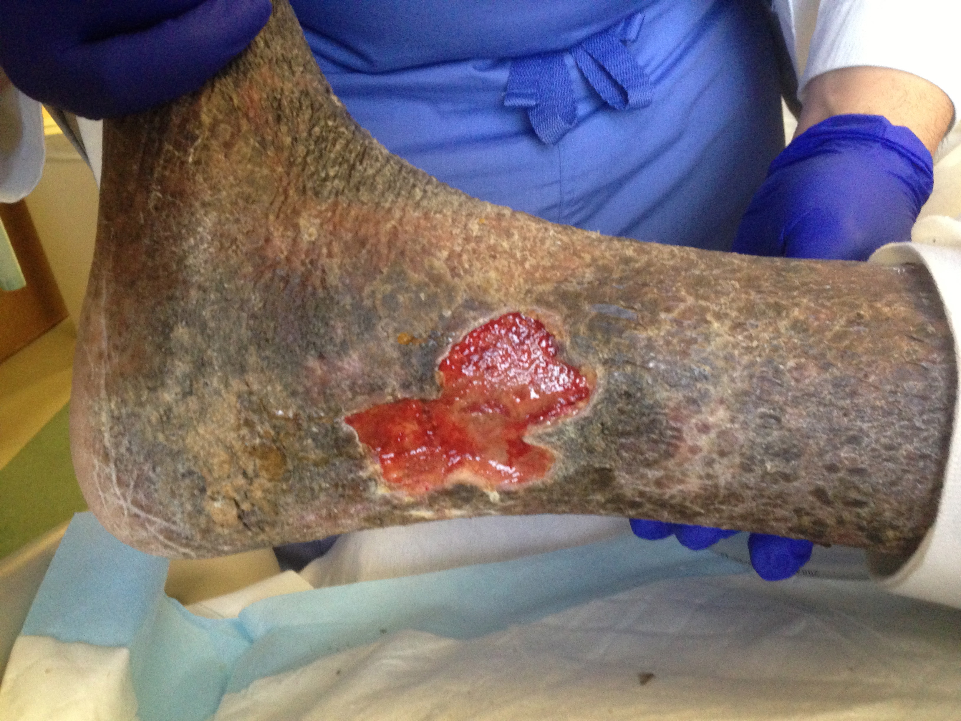 <p>Chronic Lipodermatosclerosis and Venous Stasis Ulceration