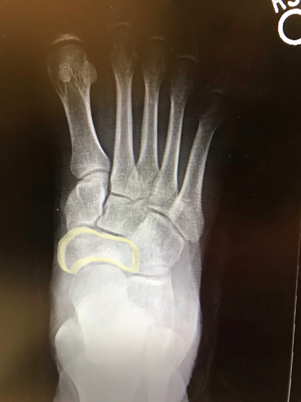 Navicular bone:
Right foot radiograph with navicular bone highlighted in yellow.