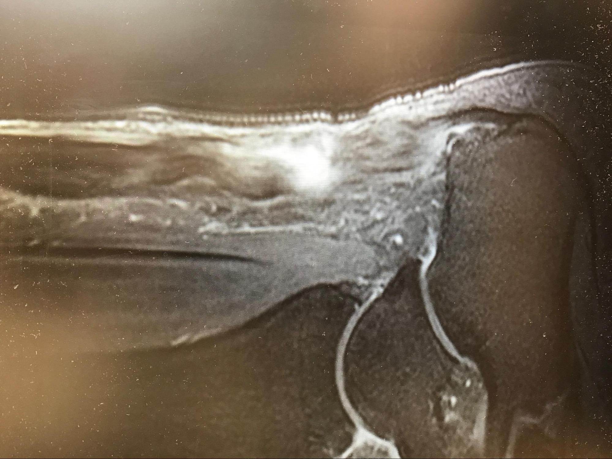 Achilles Tendon Rupture
T2 MRI demonstrating a full-thickness Achilles rupture with gapping at the classing "watershed" area