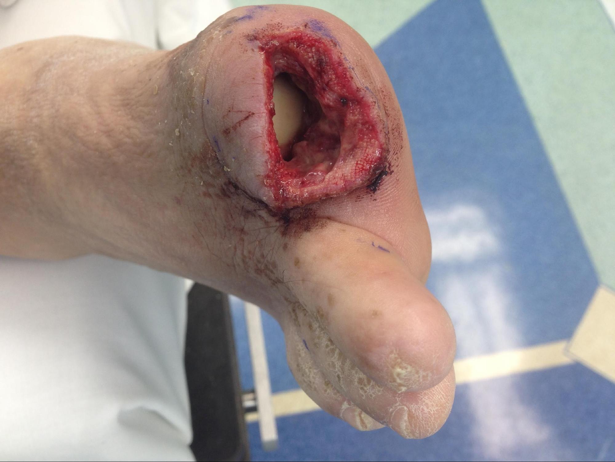 Digital Amputation
Surgical amputation of the right hallux secondary to osteomyelitis