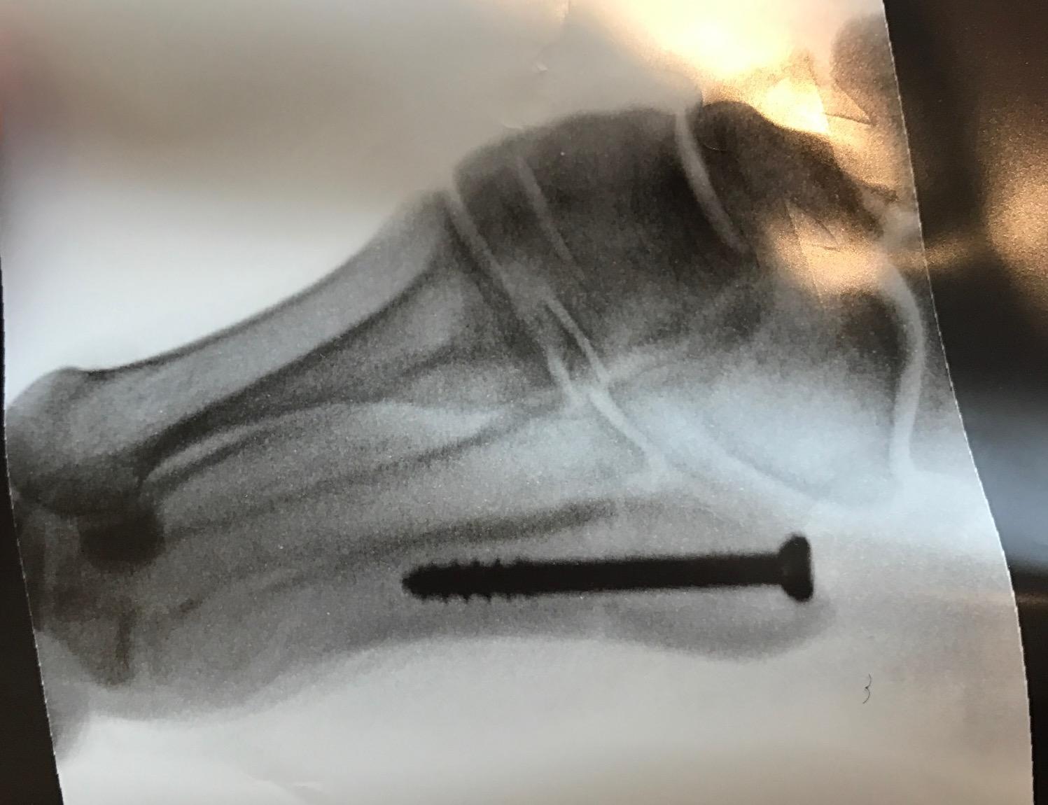 Jones Fracture
Jones fracture status post intramedullary screw fixation