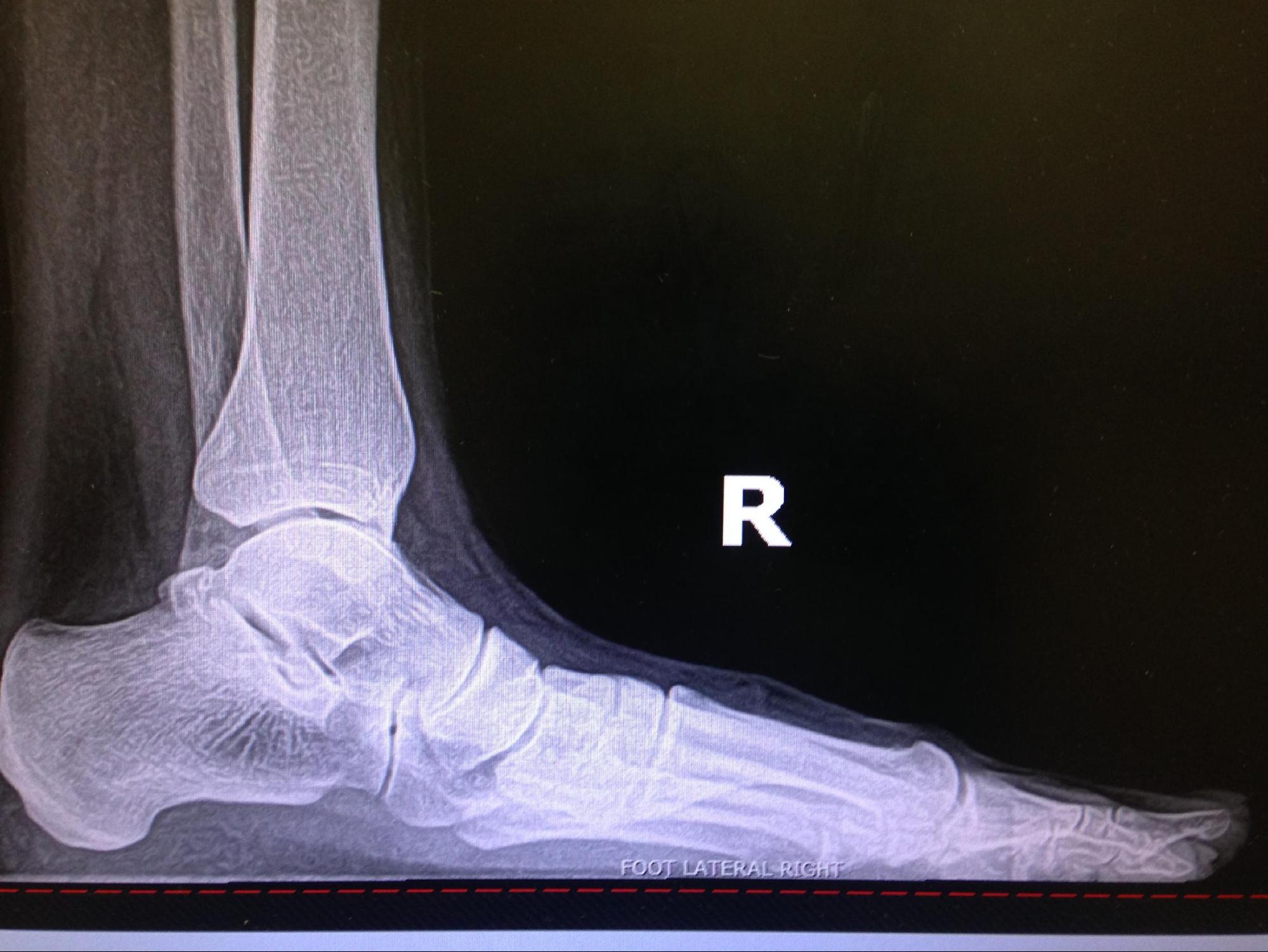 Pes Planus
Note the lack of the longitudinal arch, increased talar declination, and decreased calcaneal pitch.