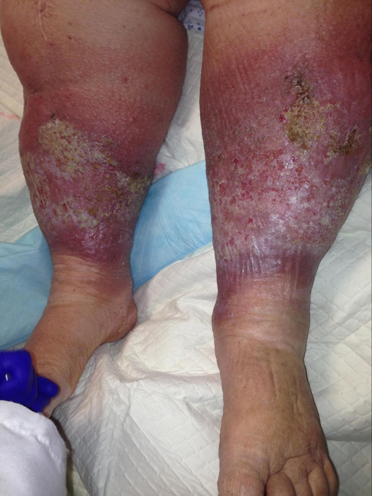 Chronic Venous Insufficiency and Lipodermatosclerosis