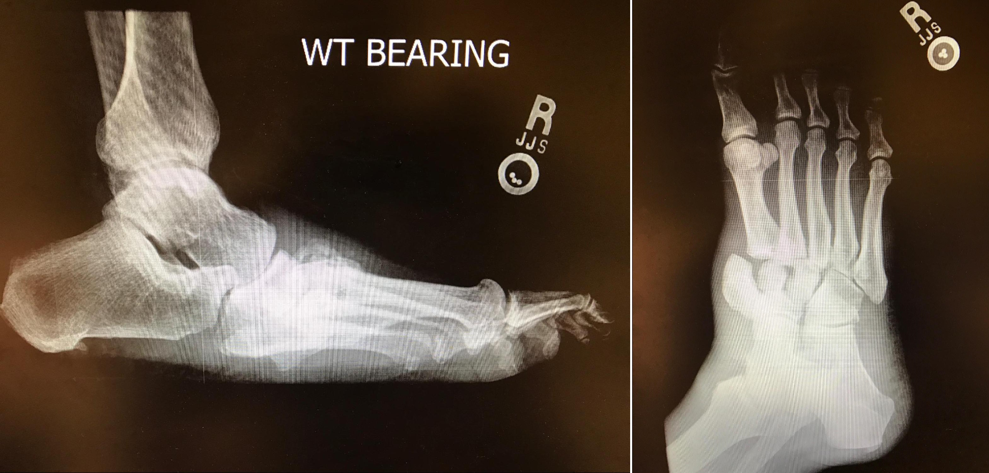 Charcot Neuropathic Osteoarthropathy
Lateral and oblique foot radiographs demonstrating Charcot foot of the midfoot