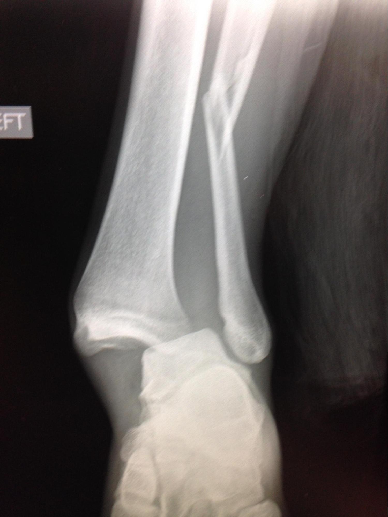 Ankle Fracture
Weber C Ankle fracture with dislocation