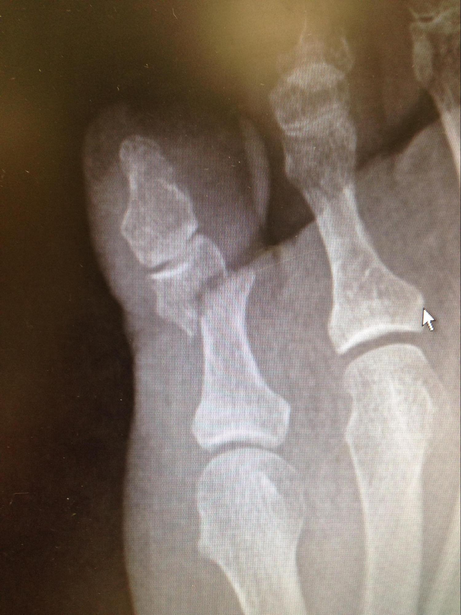 Phalanx Fracture
Transverse non-articular fracture of the 5th proximal phalanx neck.