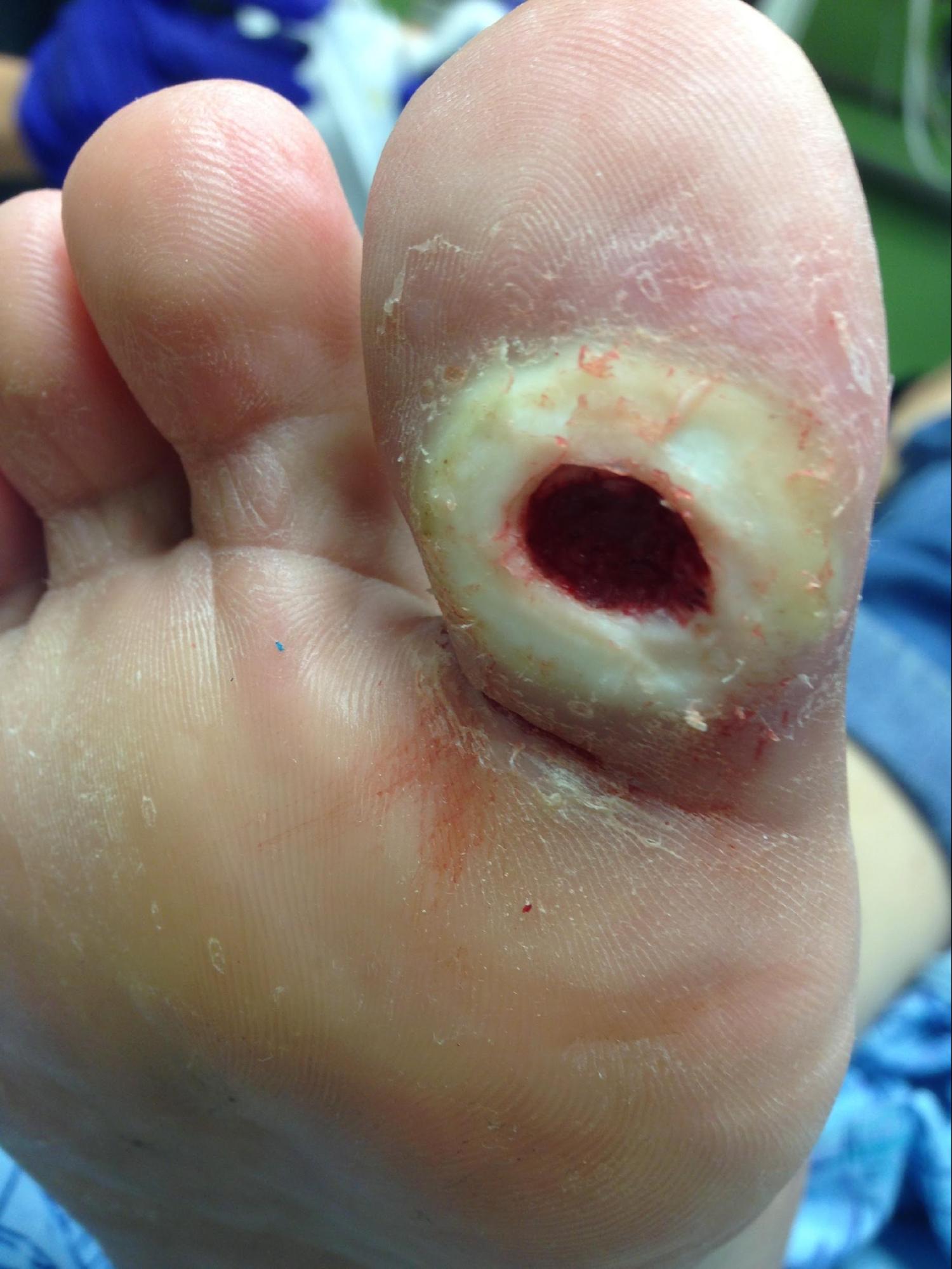 Diabetic Foot Ulcer
Neuropathic ulceration in a patient with diabetes
Note periwound callous formation. Wagner Grade 2