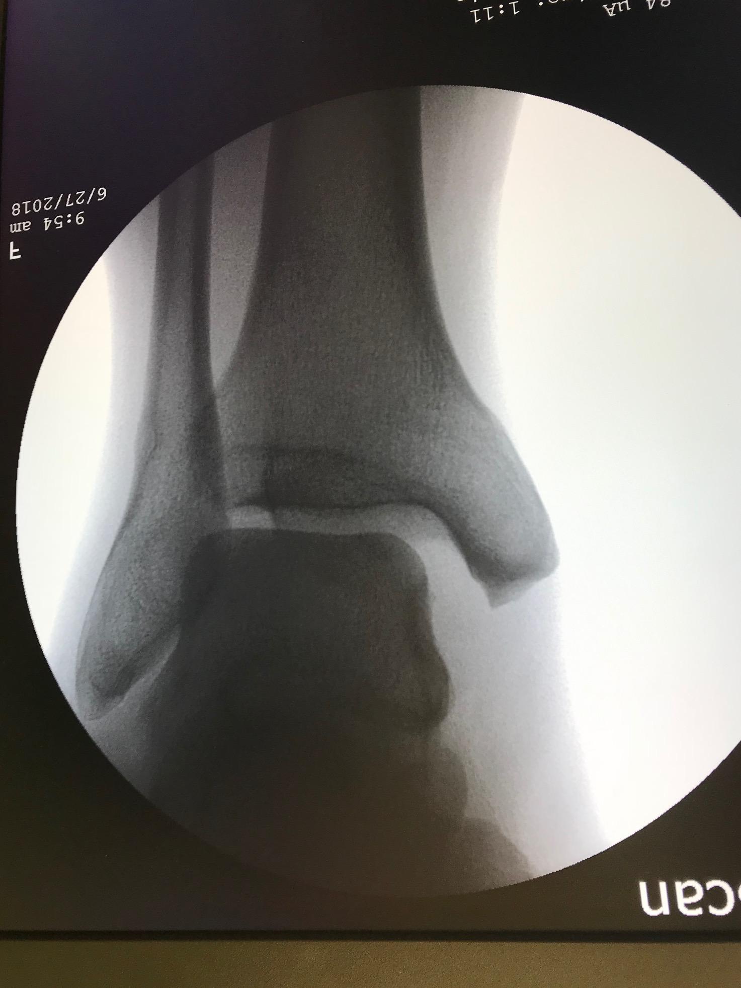 Acute Ankle Sprain
Deltoid and syndesmotic insufficiency demonstrated by medial gutter widening.