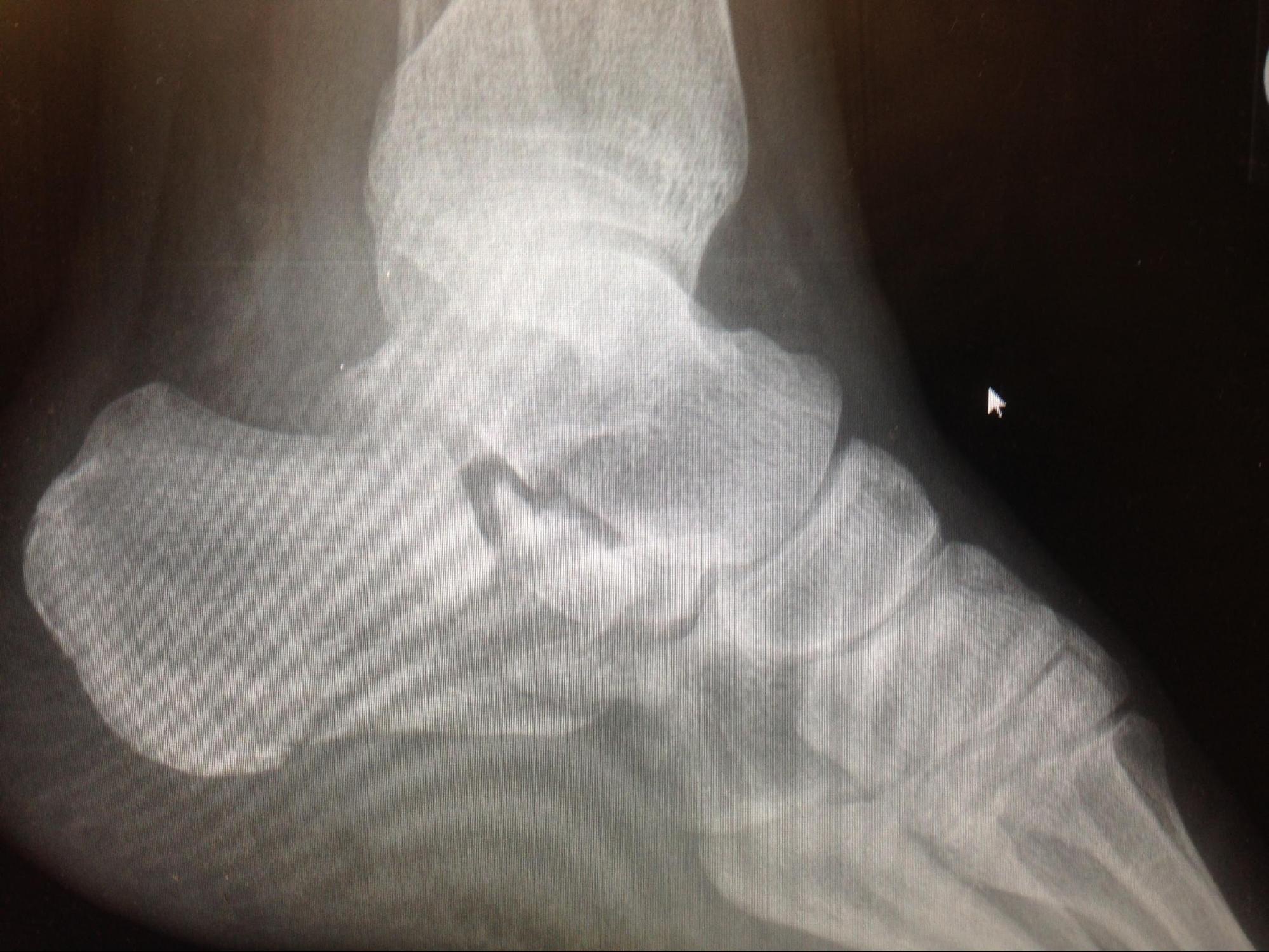 Calcaneus Fracture
Intra-articular calcaneal with subtalar joint depression.