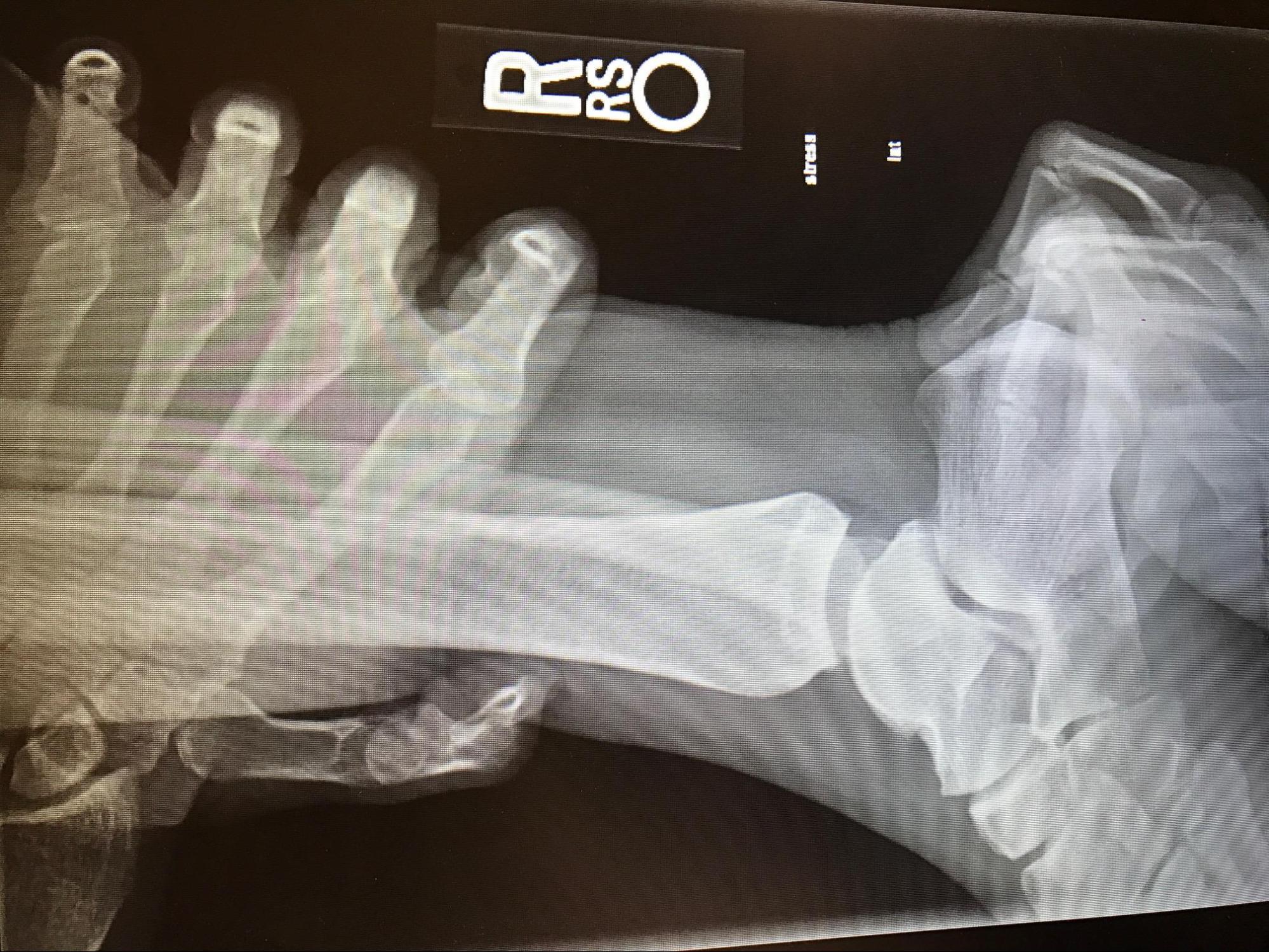 Acute Ankle Sprain 
Grade 3 ankle sprain demonstrated by anterior drawer test stress radiograph