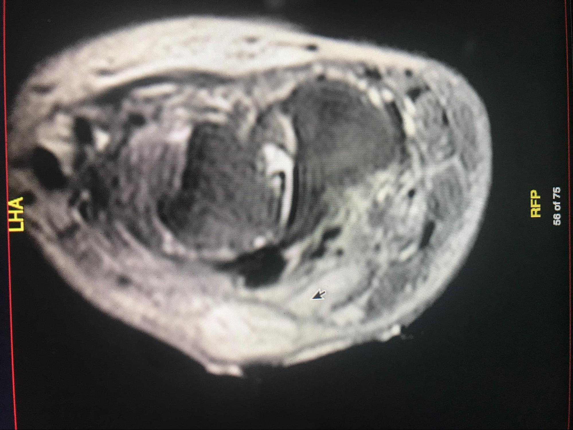 Osteomyelitis
CT Scan of chronic osteomyelitis of the leg demonstrating classic cloaca, sequestrum, and involucrum