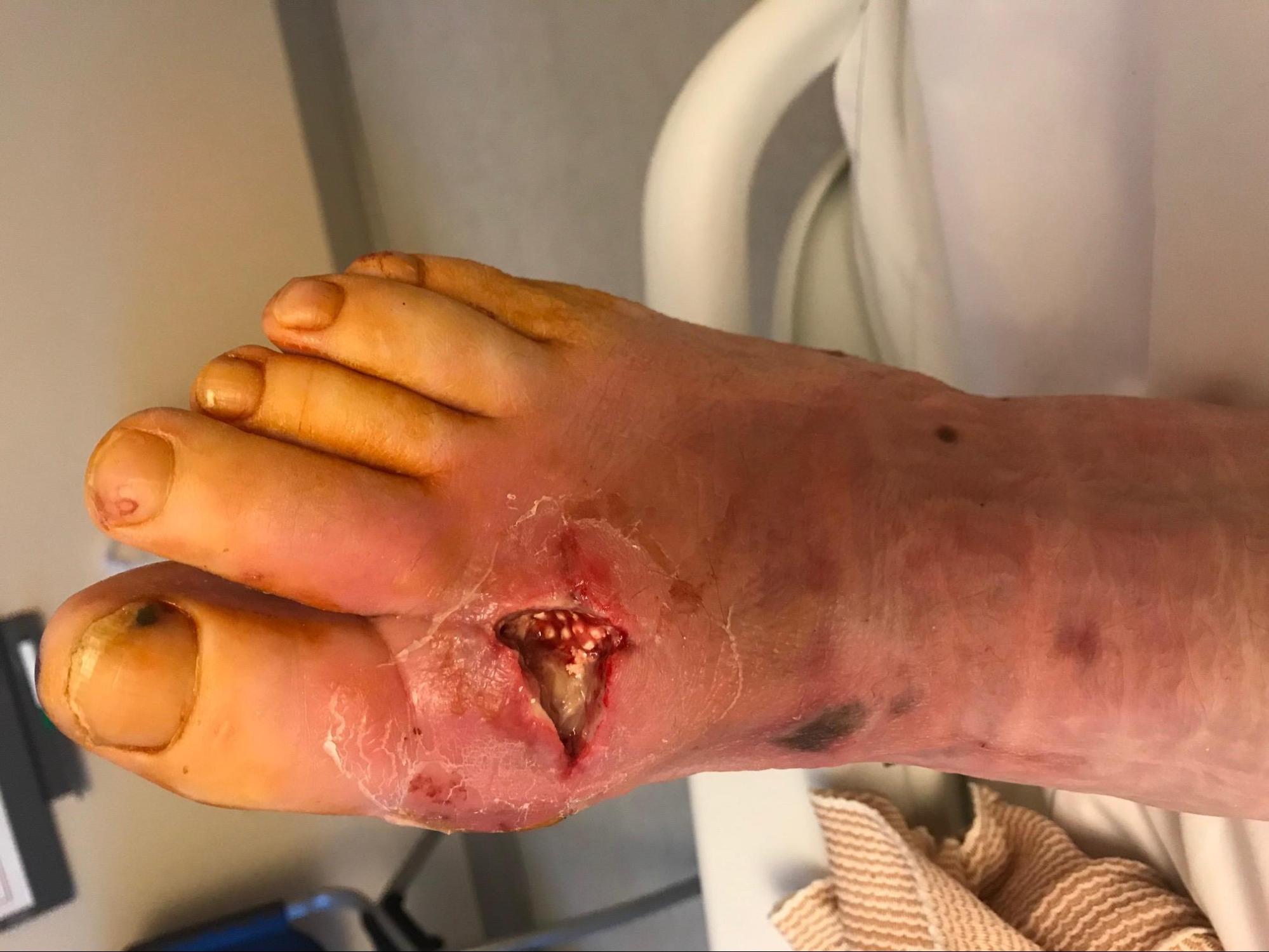 Diabetic Foot Infection
Status post incision and drainage with insertion and antibiotic beads.