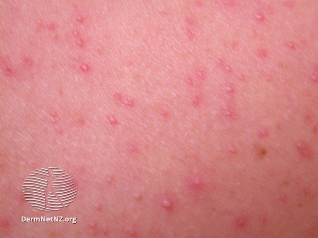 <p>Malassezia folliculitis - small, erythematous papules and pustules</p>