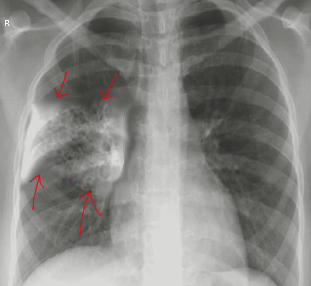 <p>Aspiration Pneumonia