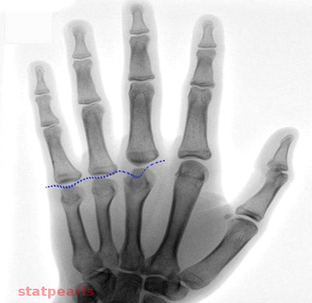 Pseudohypoparathyroidism