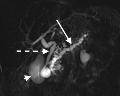 <p>Chronic Pancreatitis via MRCP