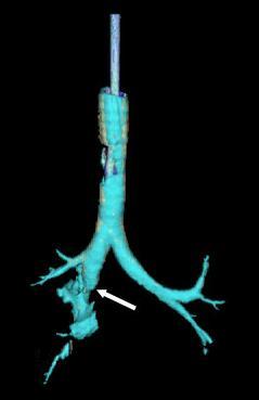 <p>Tracheal Injury</p>