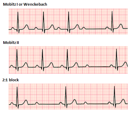 Second degree heart block