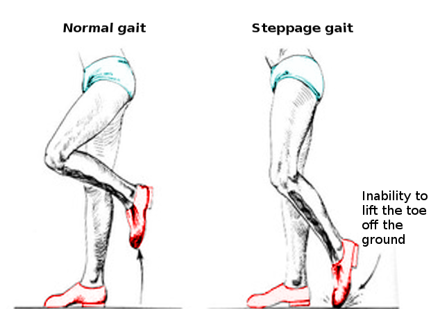 Steppage gait