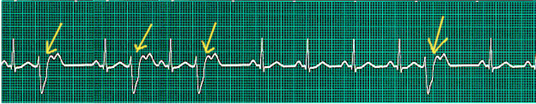 <p>Premature Ventricular Complexes