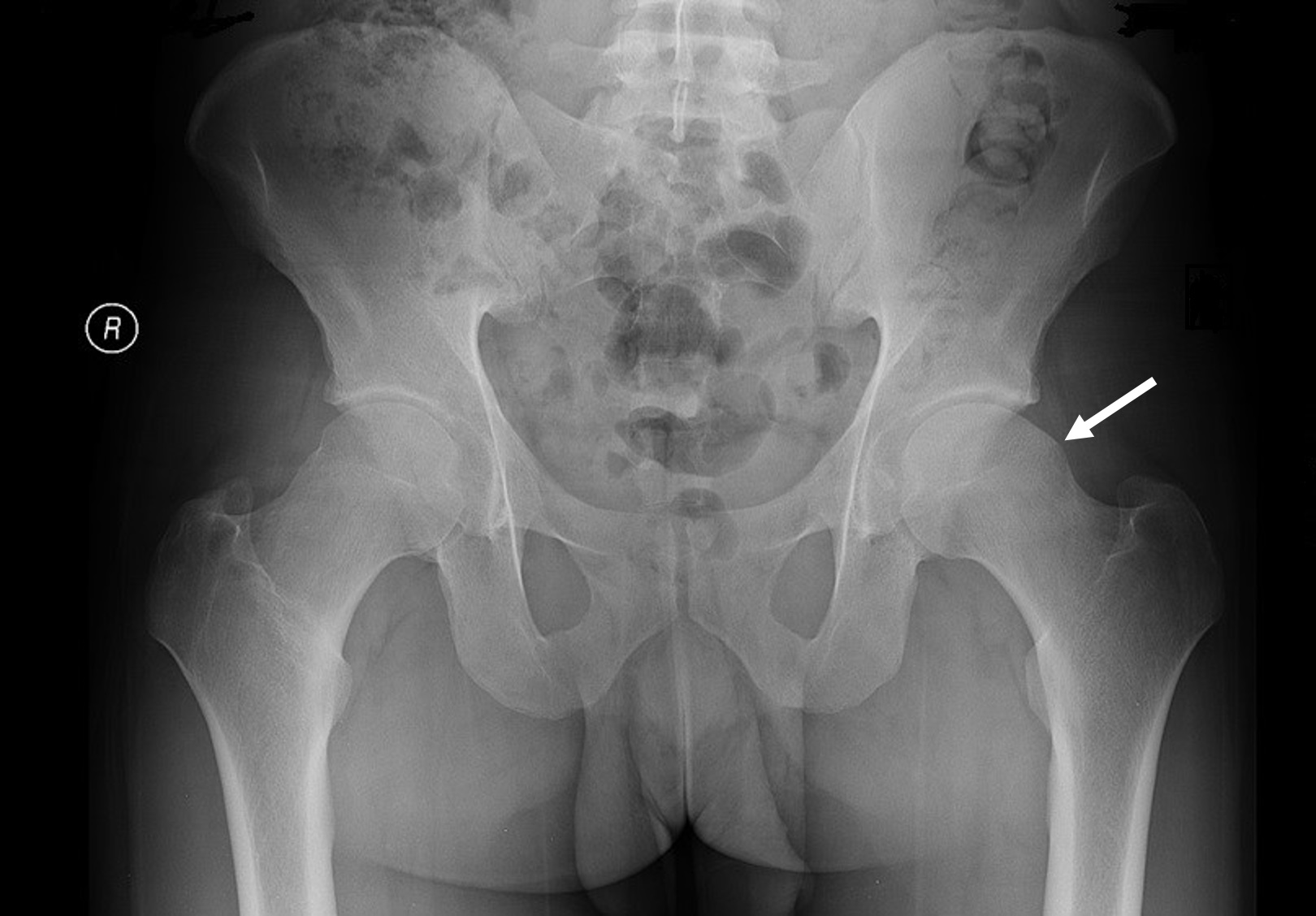 AP pelvis x-ray demonstrating a left hip cam lesion (indicated by white arrow) causing femoroacetabular impingement in this patient