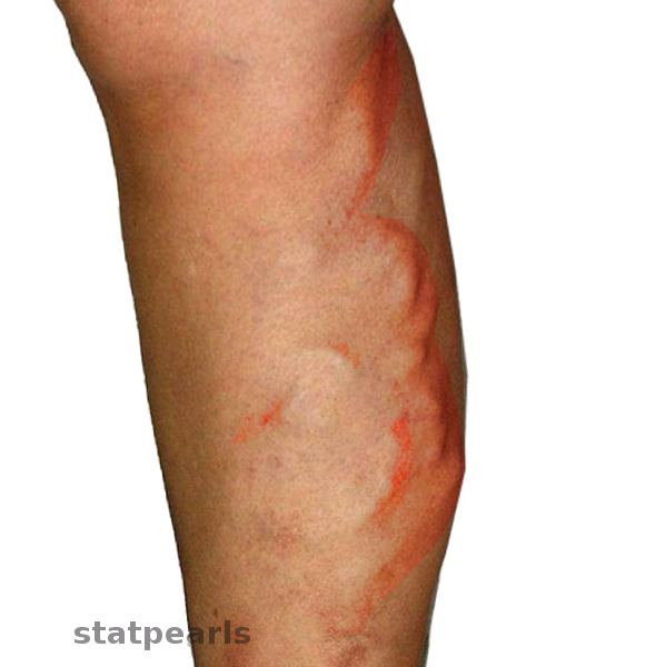 <p>Migratory Thrombophlebitis</p>