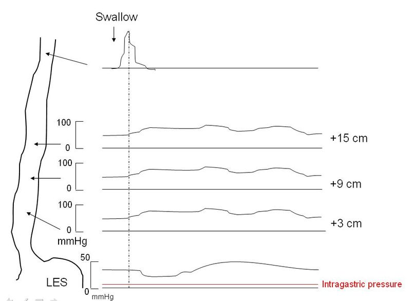 <p>Achalasia Manometry</p>