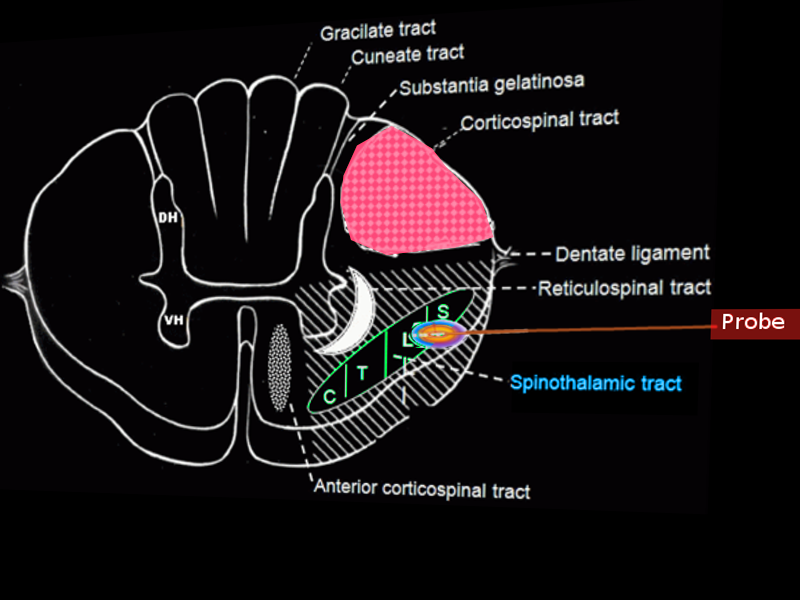 <p>Percutaneous Cordotomy</p>