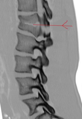 Chance fracture