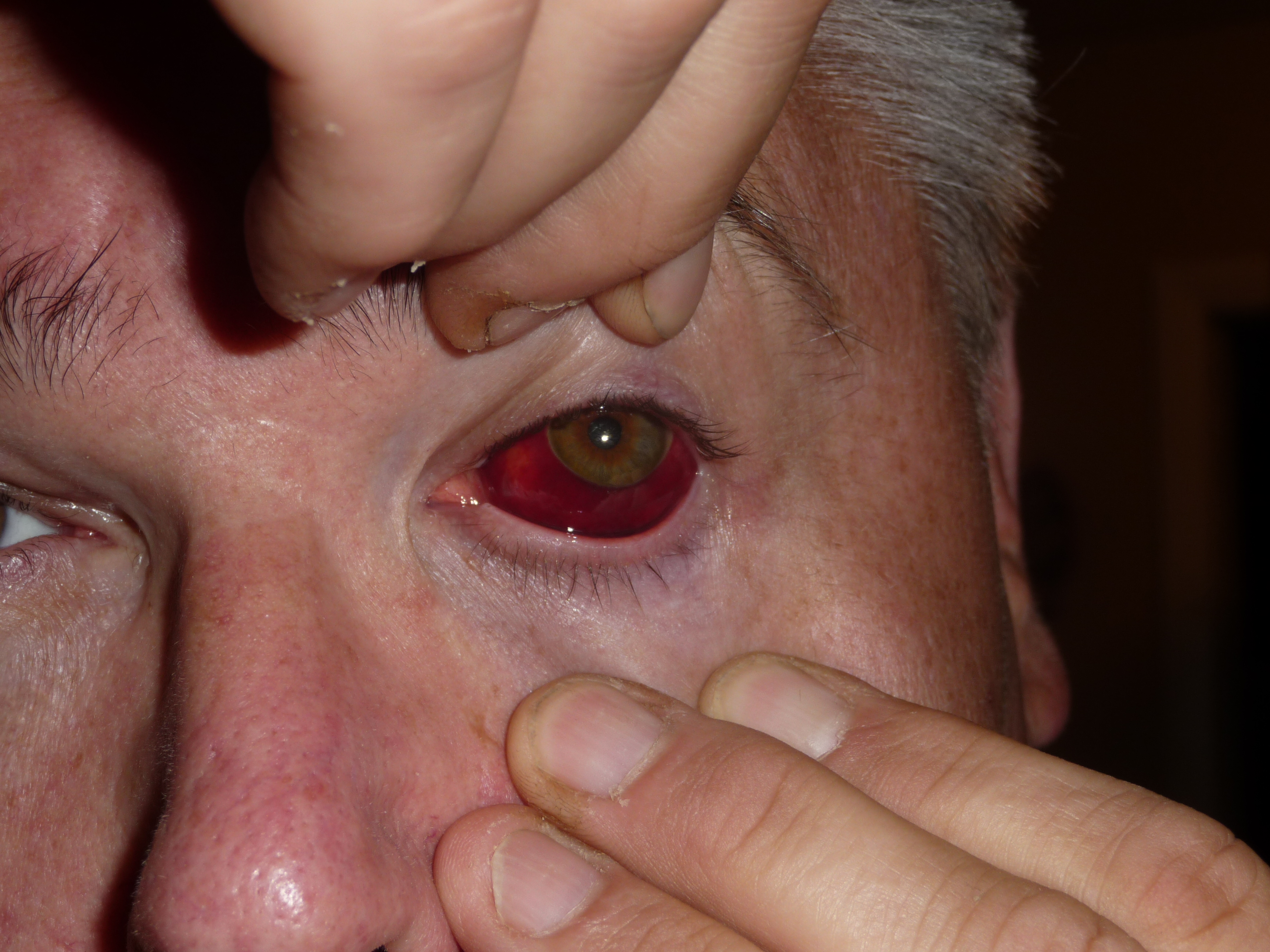 <p>Subconjunctival Hemorrhage