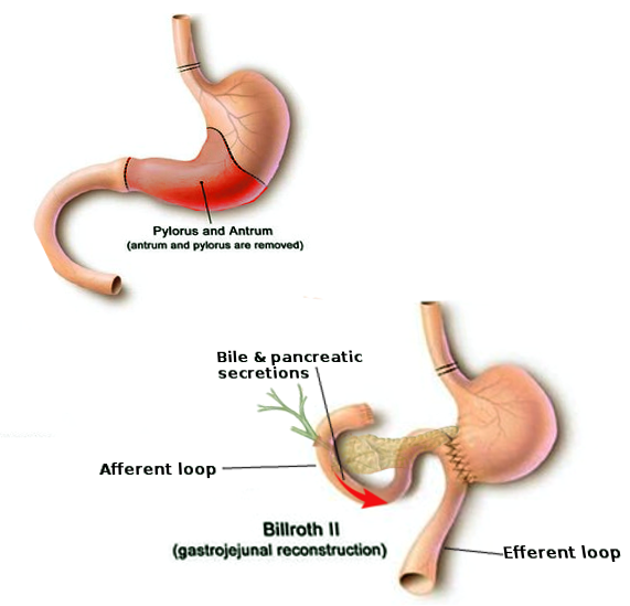 Afferent loop anatomy