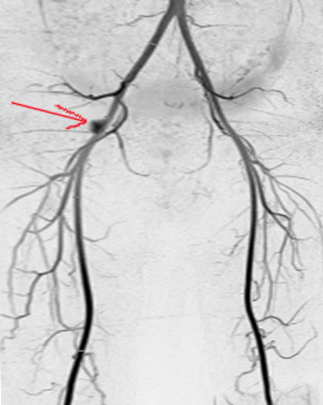 <p>Femoral Artery Aneurysm</p>