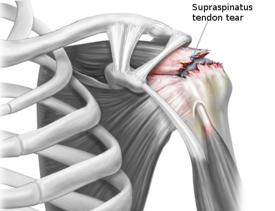 Rotator cuff tear