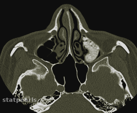 Acute sinusitis