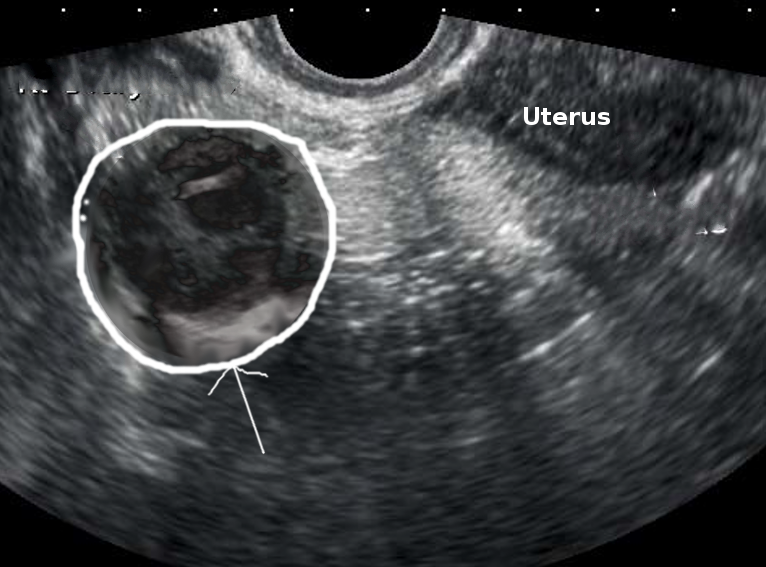 Right tuboovarian abscess