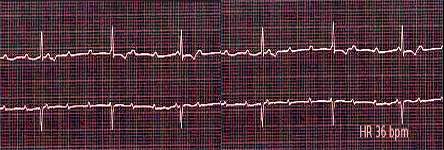 Third degree heart block